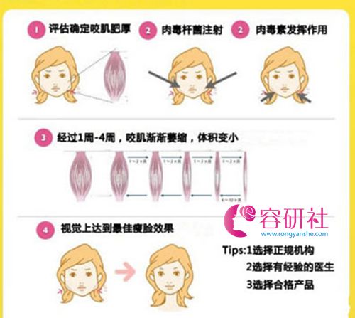 韩国普罗菲耳profile整形医院瘦脸的作用原理图