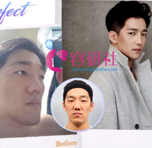韩国普罗菲耳profile面部轮廓+双鄂手术案例