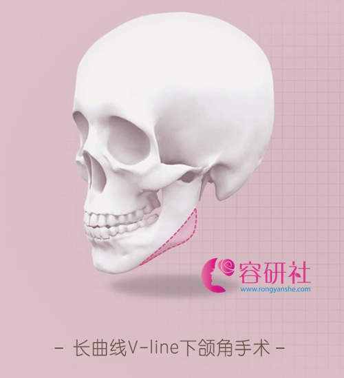 韩国profile普罗菲耳整形医院v-line下颌角手术