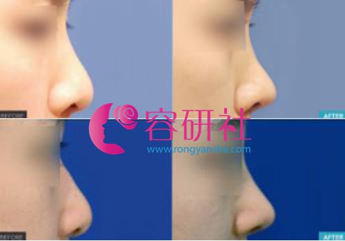 韩国profile普罗菲耳整形医院鼻综合手术案例