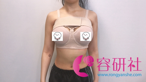 韩国普罗菲尔整形医院假体隆胸束身衣