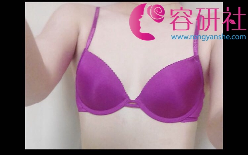 韩国普罗菲耳整形假体隆胸案例
