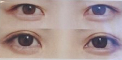 韩国CRAPAS医院眼睛修复案例