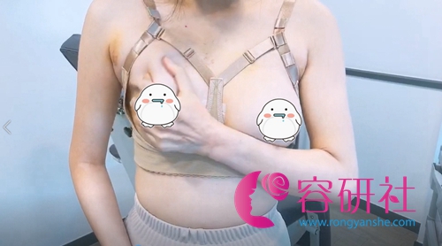 韩国profile普罗菲耳整形外科假体隆胸修复效果