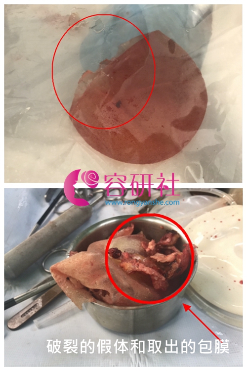 韩国profile医院假体隆胸修复取出的包膜