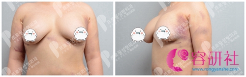 韩国profile医院隆胸修复术前