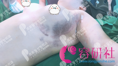 韩国profile医院隆胸修复术后