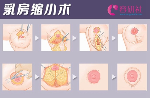 韩国普罗菲耳医院乳房缩小的几种方式