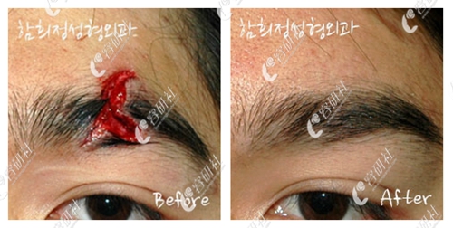 韩国dr.ham医院疤痕治疗案例