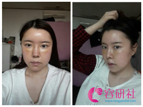 韩国新帝瑞娜整形医院求美者术后一周照片
