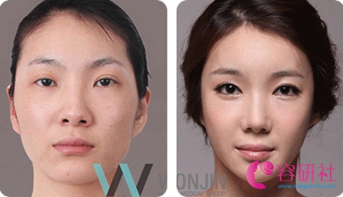 韩国原辰整形外科眼鼻整形案例