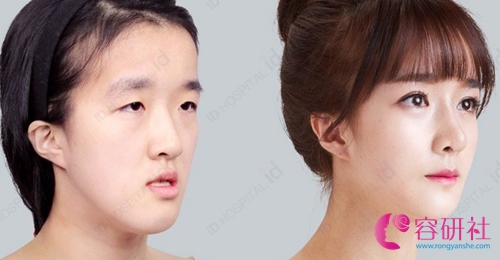 韩国id整形外科眼鼻整形案例