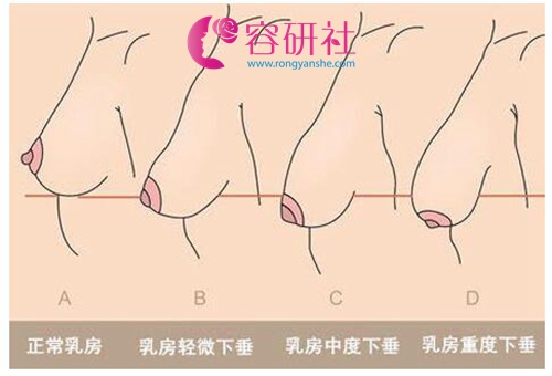 韩国profile普罗菲耳医院改善乳房下垂程度示意图