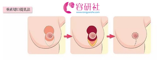 韩国profile普罗菲耳医院改善乳房提升术的方法