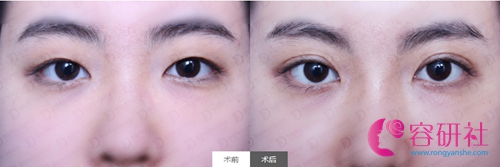 韩国女神医院双眼皮整形案例前后对比