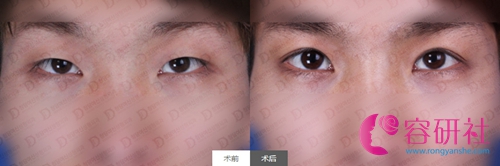 韩国女神整形医院双眼皮案例