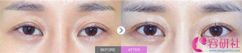 韩国秀美颜整形外科眼睛修复案例