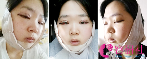 韩国新帝瑞娜医院双鄂手术日记术后三天