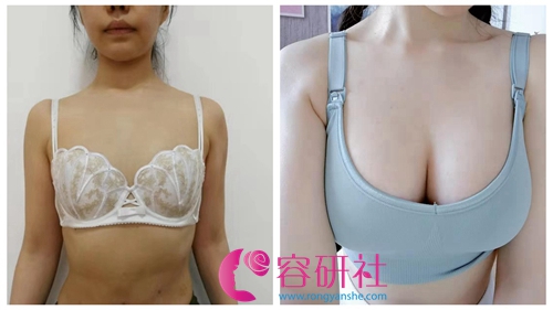 韩国普罗菲耳profile医院假体隆胸案例