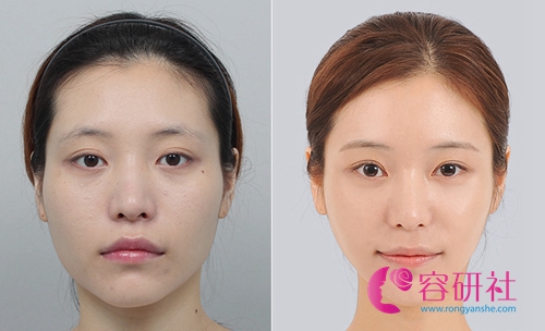 韩国DA医院面部轮廓手术案例
