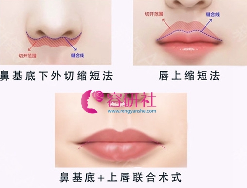 韩国HB整形外科李炫直院长嘴唇整形手术方式
