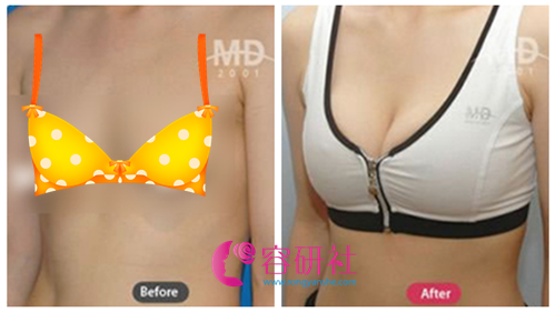 韩国MD医院乳房下垂矫正案例