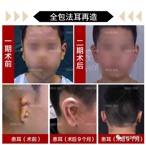 郭树忠教授肋软骨耳部再造术案例