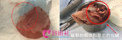 韩国普罗菲耳医院隆胸手术中取出来的包膜