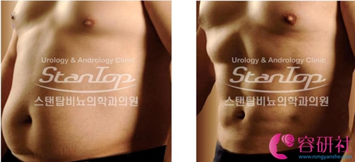 韩国世檀塔男科医院腹肌形成术真实案例