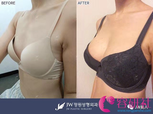 韩国jw整形外科假体隆胸日记