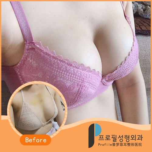 韩国profile普罗菲耳整形外科假体隆胸日记