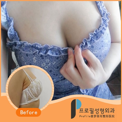 韩国profile普罗菲耳整形外科假体隆胸日记