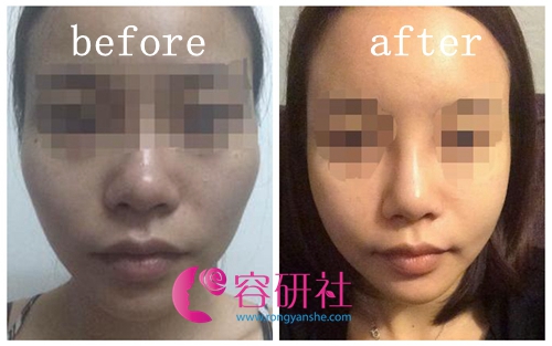 韩国遇见美整形医院下颌角手术案例