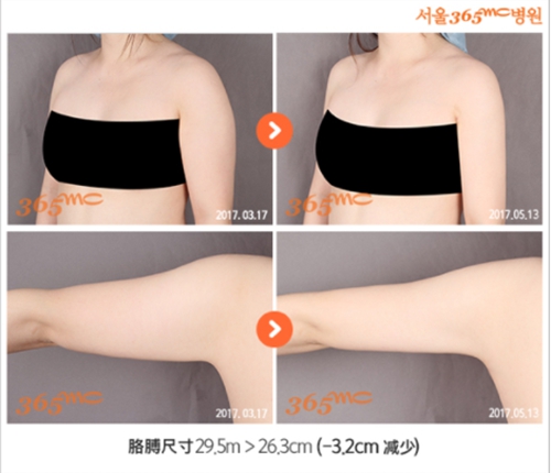 韩国365mc医院手臂吸脂案例