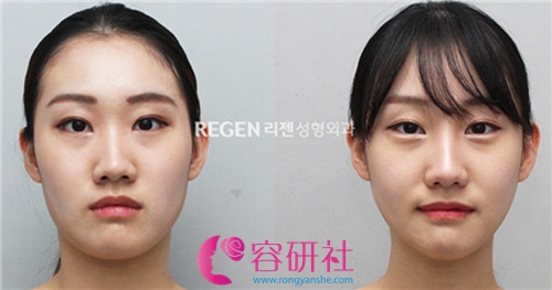 韩国丽珍整形外科轮廓三件套手术案例