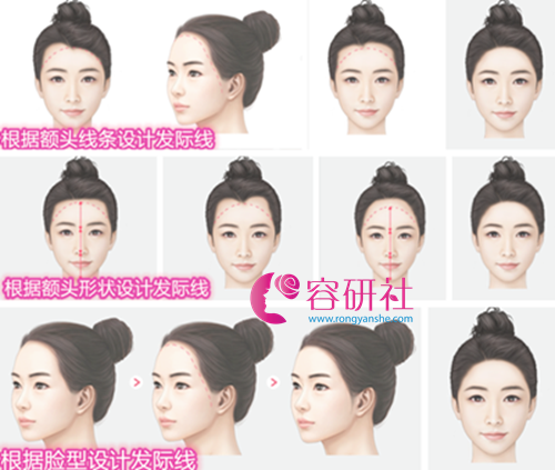韩国毛杰琳根据脸型设计植发方案
