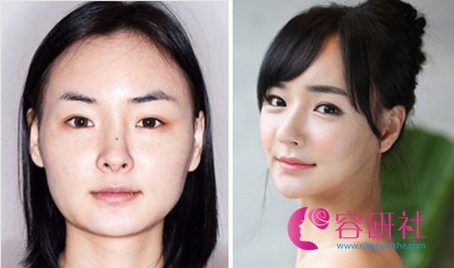 韩国博朗温整形外科隆鼻手术前后对比图