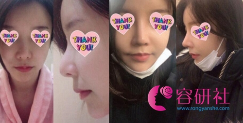 韩国博朗温整形外科隆鼻前后图片