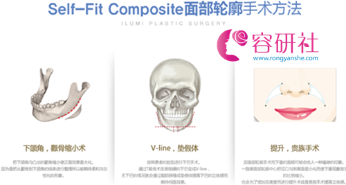 韩国一路美整形外科Self-Fit Composite面部轮廓整形术