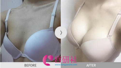 高难度胸部修复案例——韩国ucanb整形外科