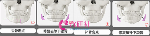 韩国创造美轮廓整形医院下颌角修复