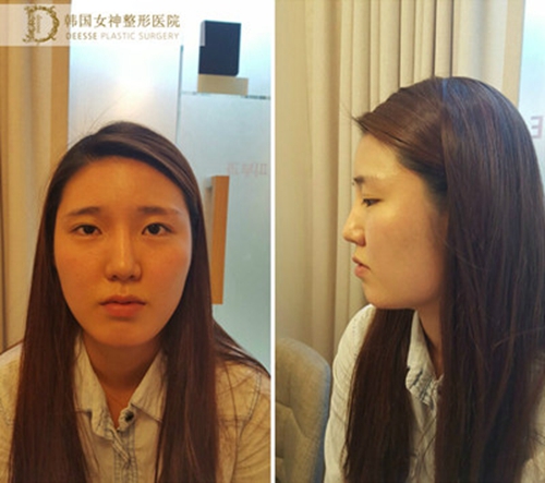 韩国女神整形外科 轮廓三件套手术前