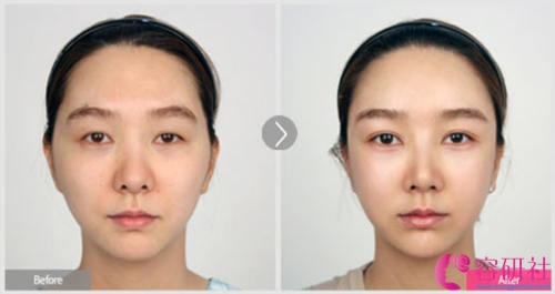 韩国faceline整形外科面部填充案例