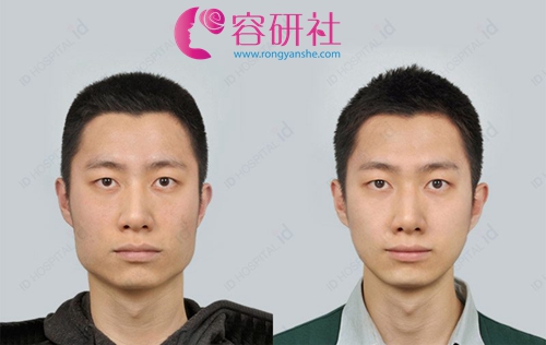 韩国id医院男士面部轮廓整形案例