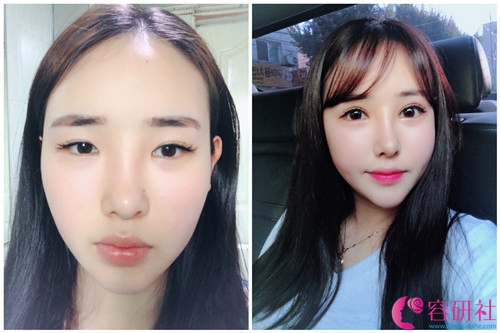 韩国pop整形外科眼部综合手术案例