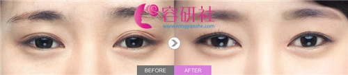 韩国秀美颜整形外科眼修复案例