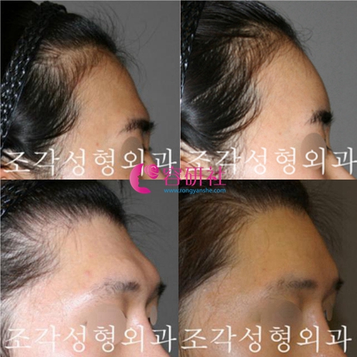韩国雕刻整形外科额头后缩骨水泥填充手术案例