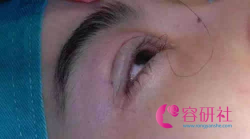 韩国纯真医院双眼皮手术缝合线体