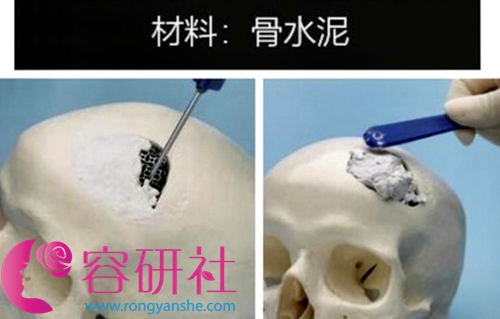 韩国雕刻医院后脑勺填充项目