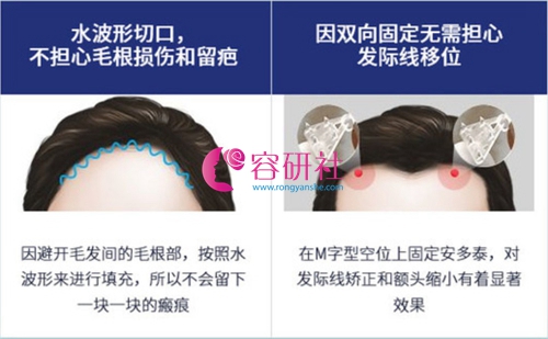 韩国profile普罗菲耳整形外科额头缩小术固定特色
